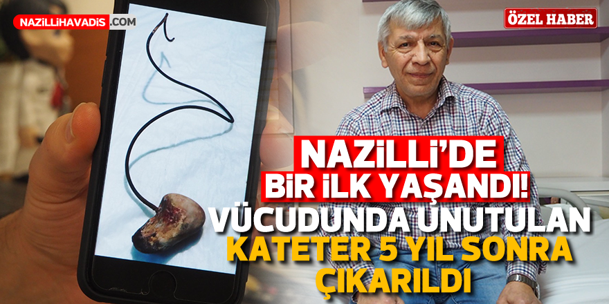 Nazilli'de bir ilk yaşandı ! Vücudunda unutulan 28 santimlik kateter 5 yıl sonra çıkarıldı