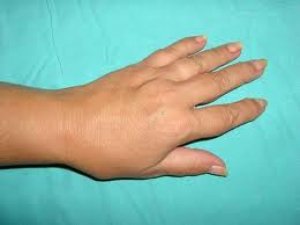 El Parmaklarındaki Ağrı ve Şişliklere Dikkat