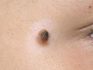 Çapı 20 Santimden Büyük Benler Kanser Riski Taşıyor