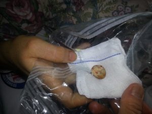 Safra Kesesinden Çıkan Taşın Büyüklüğü Şaşırttı