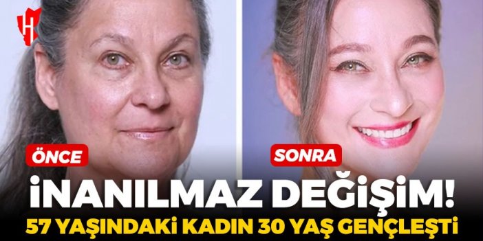 Estetik ameliyatla inanılmaz değişim: 57 yaşındaki kadın 30 yaş gençleşti