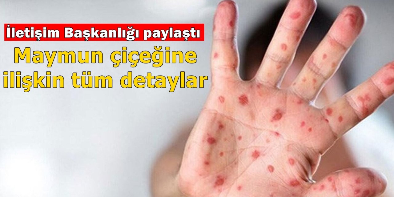 Maymun çiçeği virüsü nasıl bulaşır? Tüm detaylar haberimizde