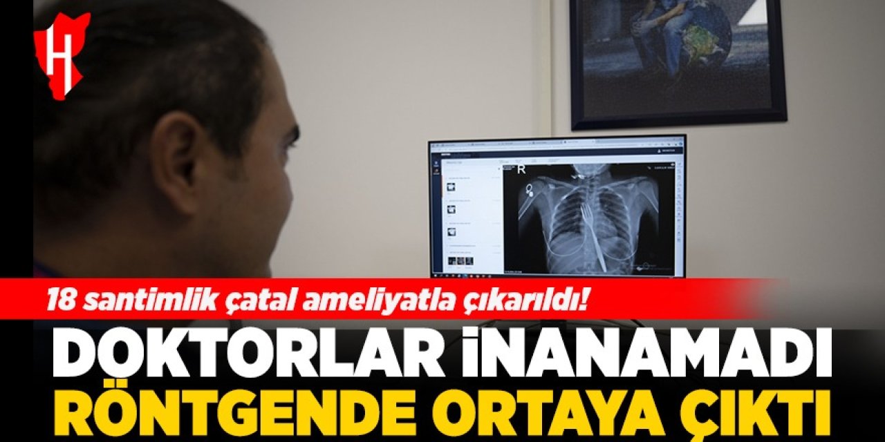 Aydın'da bu da oldu, 18 santimlik çatalı yuttu!