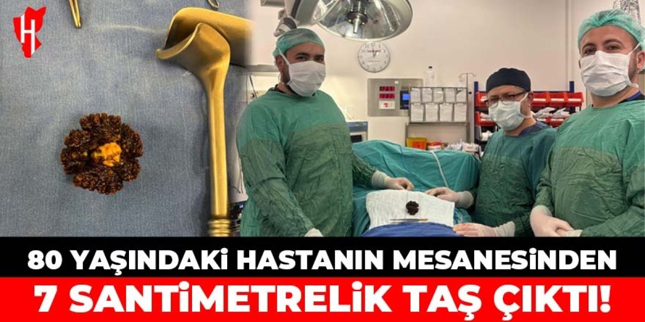 80 yaşındaki hastanın mesanesinden 7 santimetrelik taş çıktı!