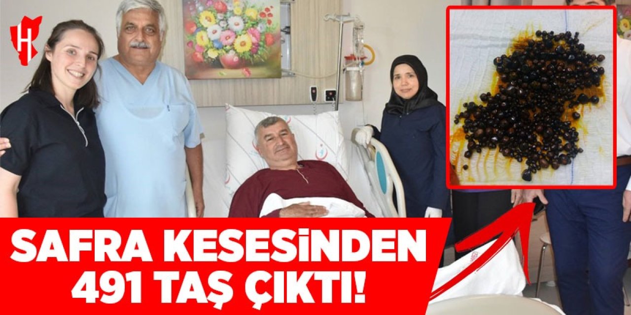 Safra kesesinden 491 taş çıktı