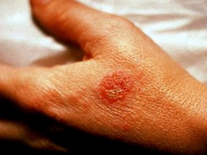 Egzama Şikayetleri Sıcak Havalarda Artıyor