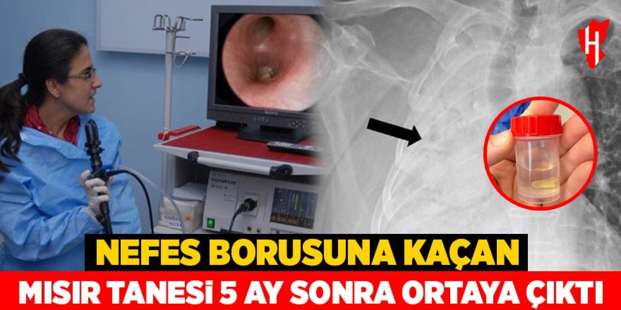 Nefes borusuna kaçan mısır tanesi 5 ay sonra ortaya çıktı