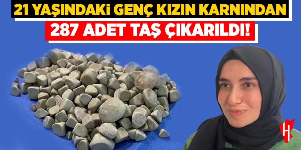 21 yaşındaki genç kızın karnından 287 tane taş çıkarıldı!