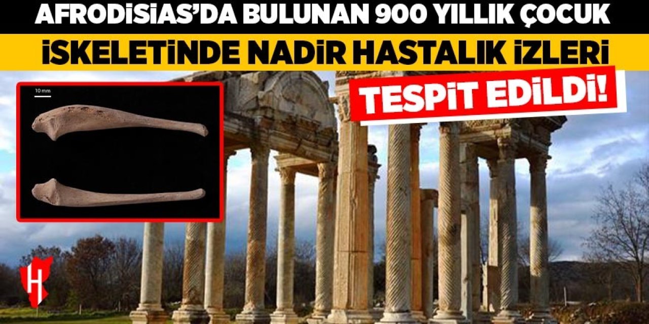 Afrodisias’da bulunan 900 yıllık çocuk iskeletinde nadir hastalık izleri tespit edildi