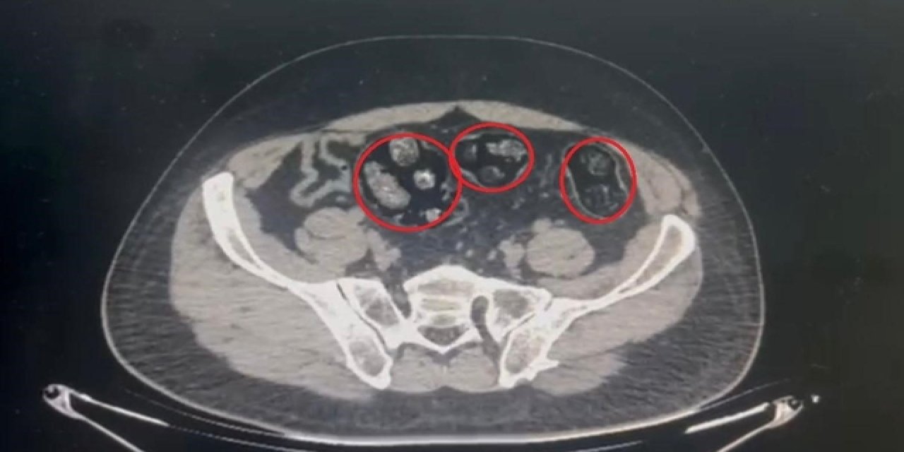 Yolcunun midesinden 62 parça uyuşturucu çıktı