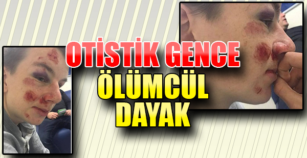 Otistik Gence Korkunç Dayak