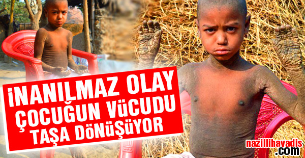 İnanılmaz Olay:Çocuğun vücudu taşa dönüşüyor