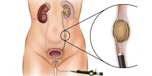 ureter-tasi-ureteroskopi-1.jpg